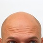 You are who you are. A hair loss odyssey... bald stories